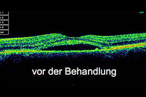 altersbedingte Makuladegeneration – Augenärztliche Gemeinschaftspraxis | Dr. Heuring, Dr. Jung & Kollegen