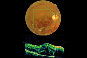 Venöser Gefäßverschluss – Augenärztliche Gemeinschaftspraxis | Dr. Heuring, Dr. Jung & Kollegen