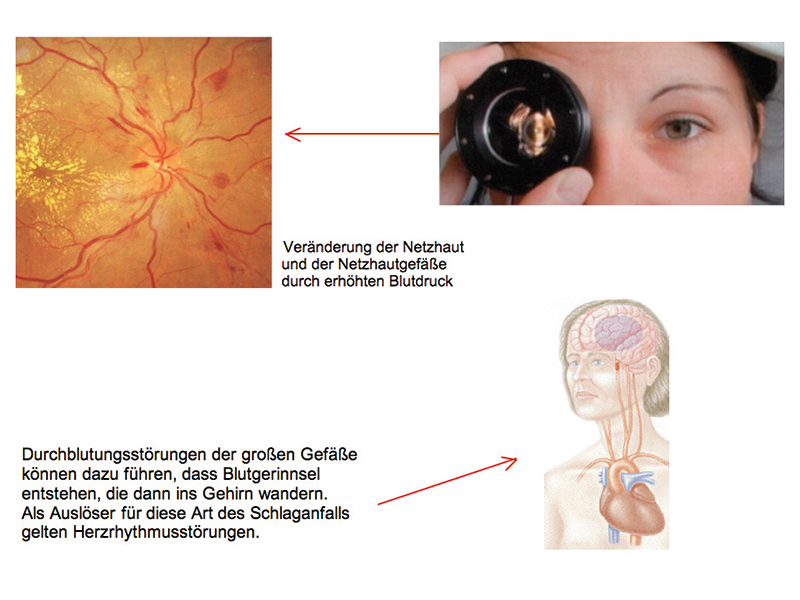 Schlaganfallprophylaxe – Augenärztliche Gemeinschaftspraxis | Dr. Heuring, Dr. Jung & Kollegen