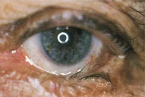Einwärtskehrung des Augenlids – Augenärztliche Gemeinschaftspraxis | Dr. Heuring, Dr. Jung & Kollegen