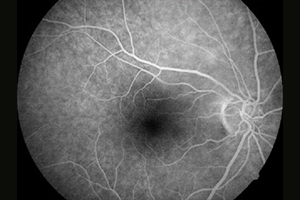 Fluoreszeinangiographie – Augenärztliche Gemeinschaftspraxis | Dr. Heuring, Dr. Jung & Kollegen