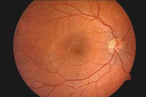 Makuladegeneration – Augenärztliche Gemeinschaftspraxis | Dr. Heuring, Dr. Jung & Kollegen