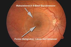 Makuladegeneration – Augenärztliche Gemeinschaftspraxis | Dr. Heuring, Dr. Jung & Kollegen