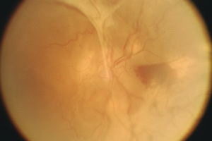 Proliferative Retinopathie – Augenärztliche Gemeinschaftspraxis | Dr. Heuring, Dr. Jung & Kollegen